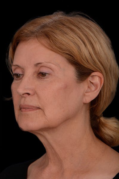 Necklift Before & After Gallery - Patient 356951 - Image 1