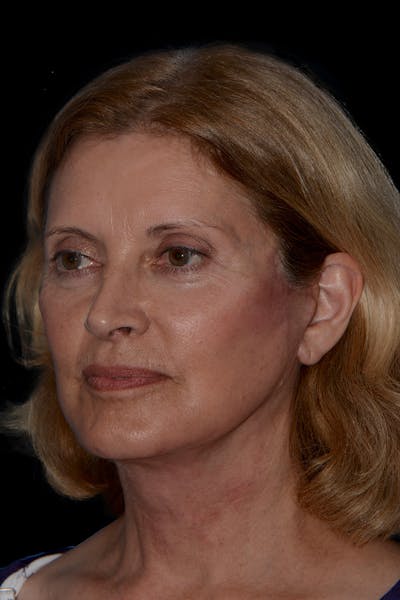 Necklift Before & After Gallery - Patient 356951 - Image 2