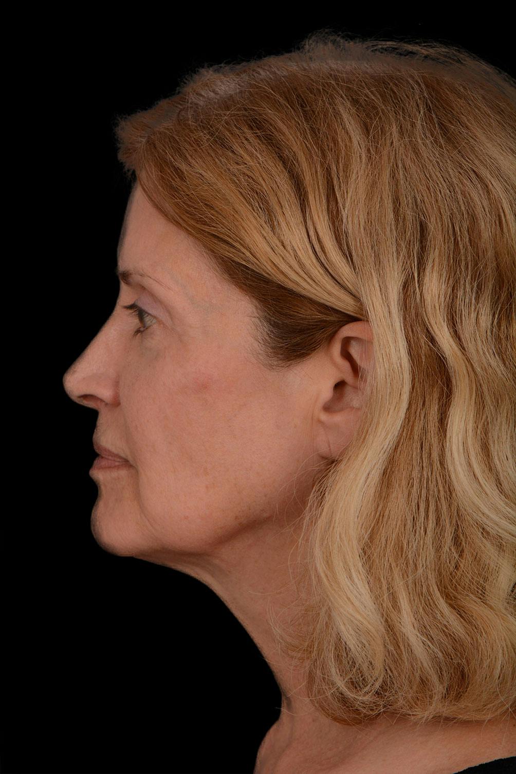 Neck Lift before and after
