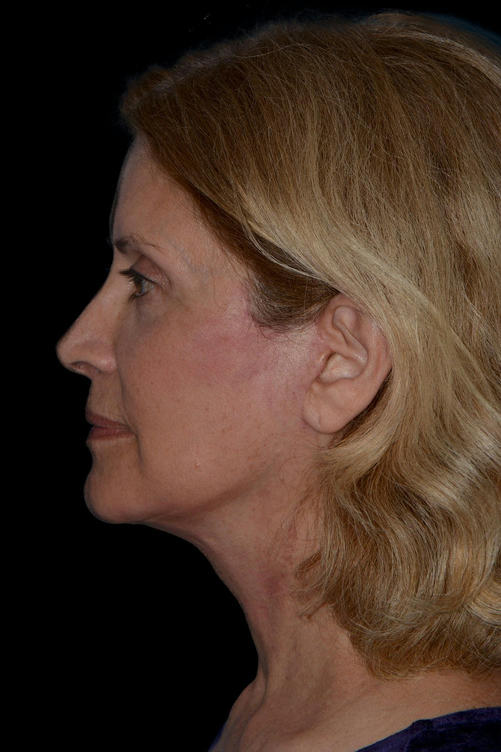 Neck Lift before and after