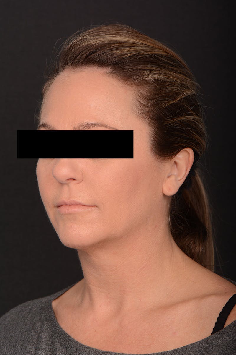 Facelift Before & After Gallery - Patient 336145 - Image 3