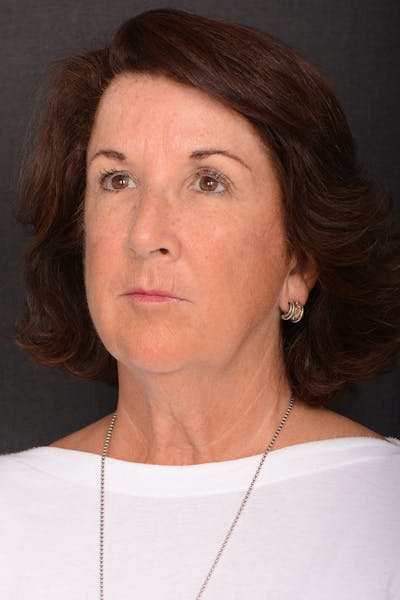 Necklift Before & After Gallery - Patient 179479 - Image 1