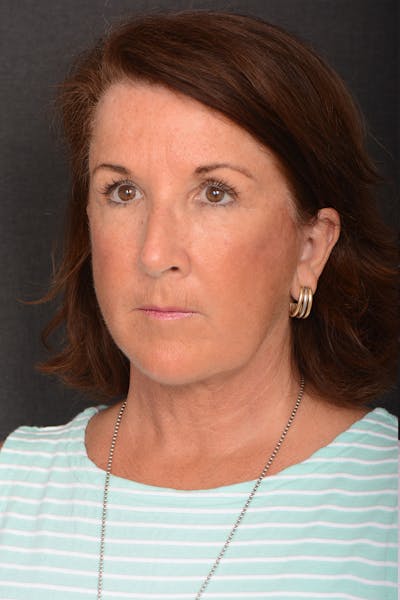 Necklift Before & After Gallery - Patient 179479 - Image 2