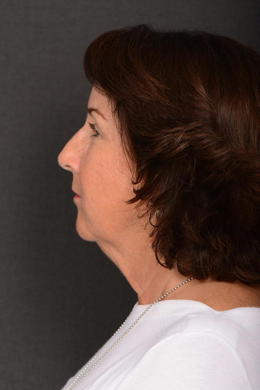 Neck Lift before and after