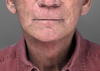 Necklift Before & After Gallery - Patient 345513 - Image 4