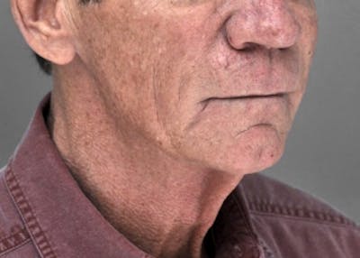 Necklift Before & After Gallery - Patient 345513 - Image 1