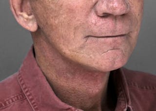 Necklift Before & After Gallery - Patient 345513 - Image 2