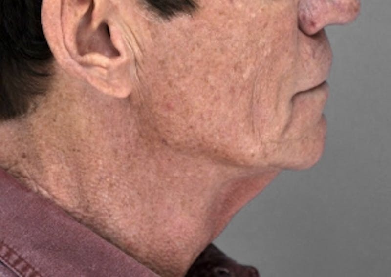 Necklift Before & After Gallery - Patient 345513 - Image 5