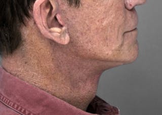 Necklift Before & After Gallery - Patient 345513 - Image 6