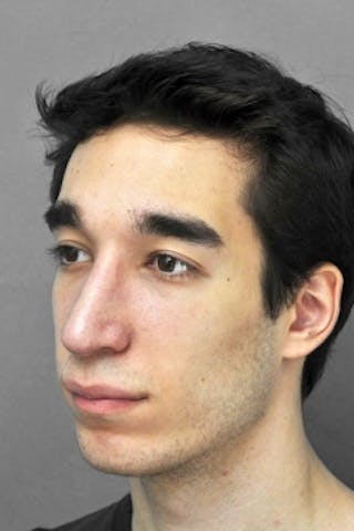 Rhinoplasty Before & After Gallery - Patient 925613 - Image 4