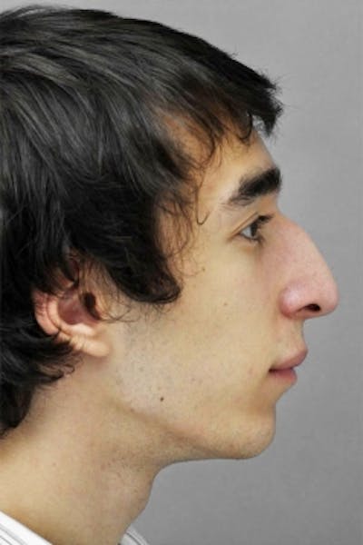 Rhinoplasty Before & After Gallery - Patient 925613 - Image 1