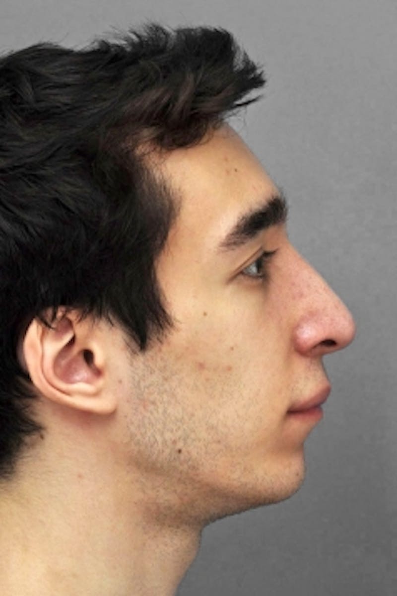 Rhinoplasty Before & After Gallery - Patient 925613 - Image 4