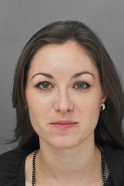 Rhinoplasty Before & After Gallery - Patient 206929 - Image 2