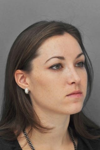 Rhinoplasty Before & After Gallery - Patient 206929 - Image 6