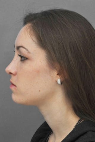 Rhinoplasty Before & After Gallery - Patient 206929 - Image 8