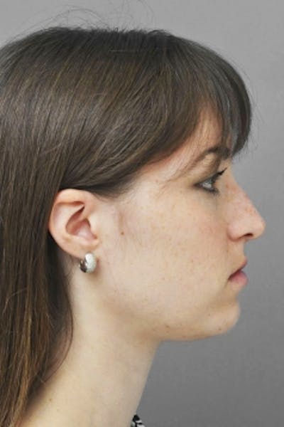 Rhinoplasty Before & After Gallery - Patient 206929 - Image 1