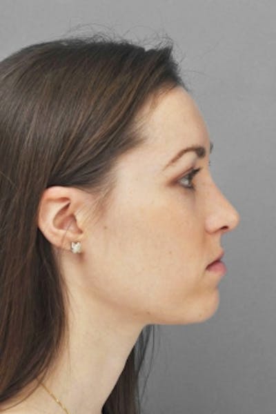 Rhinoplasty Before & After Gallery - Patient 206929 - Image 2