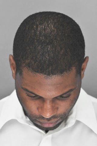 Rhinoplasty Before & After Gallery - Patient 872659 - Image 8