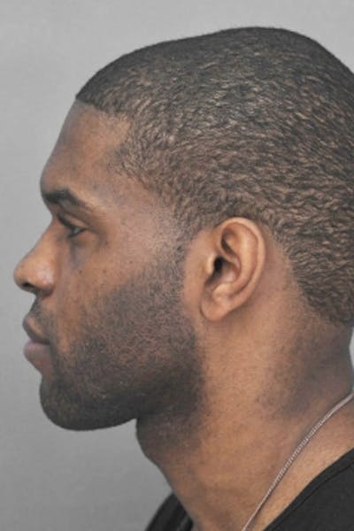 Rhinoplasty Before & After Gallery - Patient 872659 - Image 1