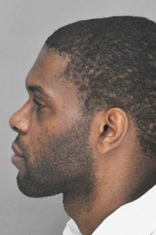 Rhinoplasty Before & After Gallery - Patient 872659 - Image 2