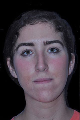 Rhinoplasty Before & After Gallery - Patient 352043 - Image 4