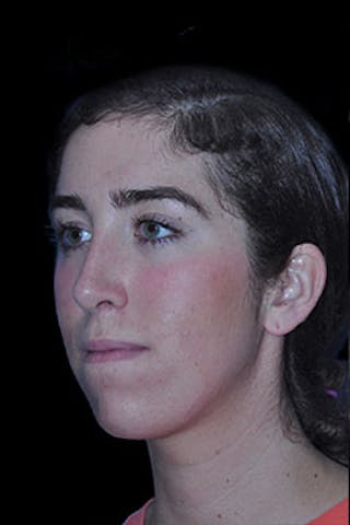 Rhinoplasty Before & After Gallery - Patient 352043 - Image 6