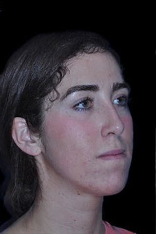 Rhinoplasty Before & After Gallery - Patient 352043 - Image 8