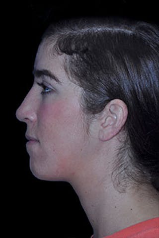 Rhinoplasty Before & After Gallery - Patient 352043 - Image 10