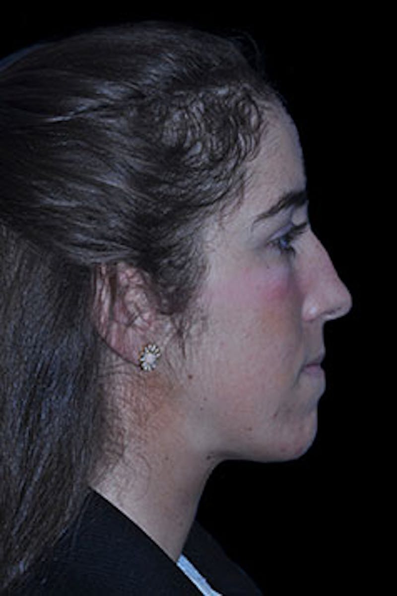 Rhinoplasty Before & After Gallery - Patient 352043 - Image 9