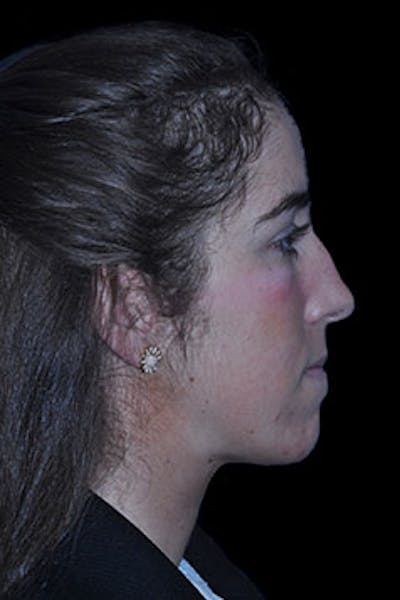 Rhinoplasty Before & After Gallery - Patient 352043 - Image 1