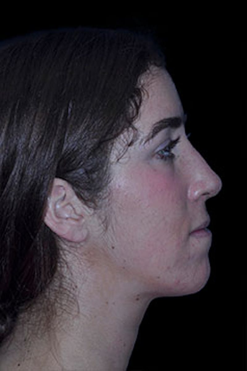 Rhinoplasty Before & After Gallery - Patient 352043 - Image 10