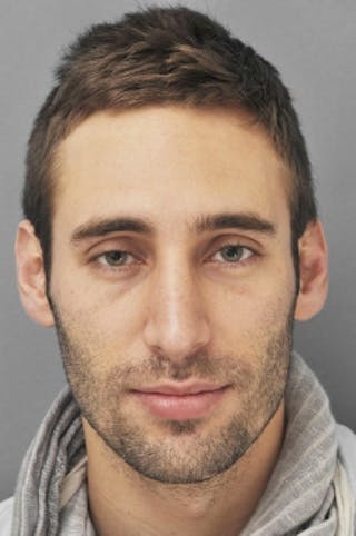 Rhinoplasty Before & After Gallery - Patient 134531 - Image 4