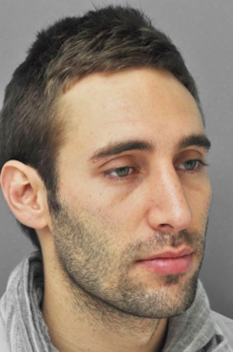 Rhinoplasty Before & After Gallery - Patient 134531 - Image 4