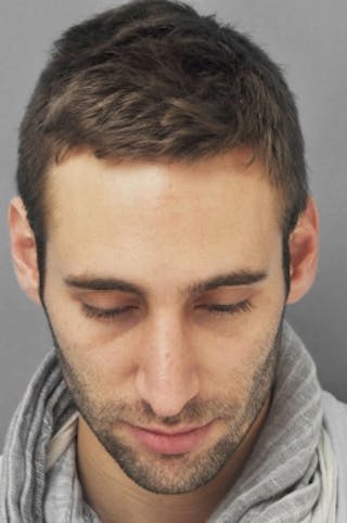 Rhinoplasty Before & After Gallery - Patient 134531 - Image 8