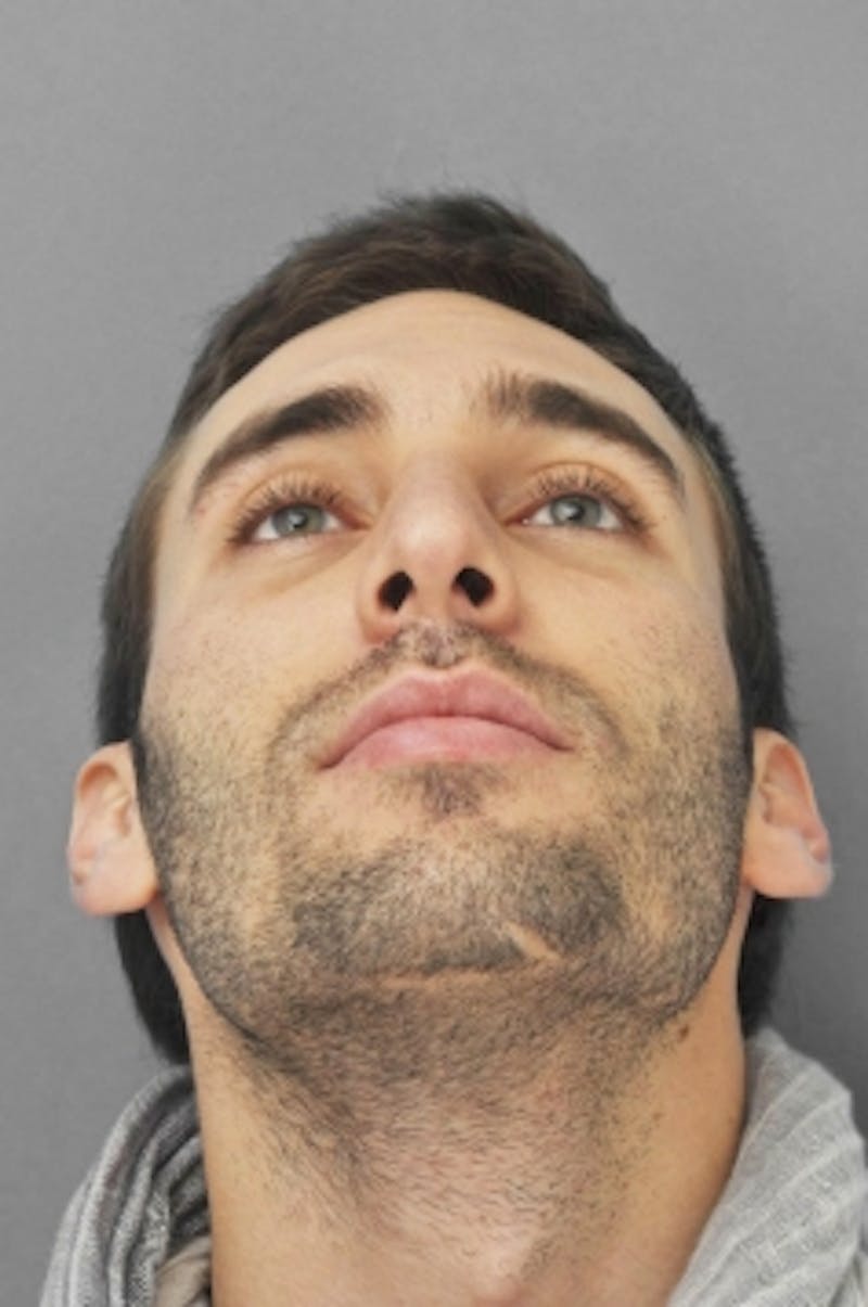 Rhinoplasty Before & After Gallery - Patient 134531 - Image 8