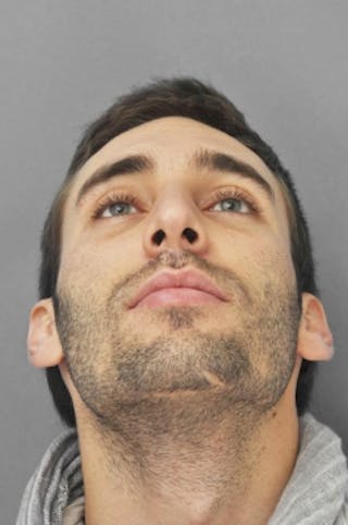 Rhinoplasty Before & After Gallery - Patient 134531 - Image 10