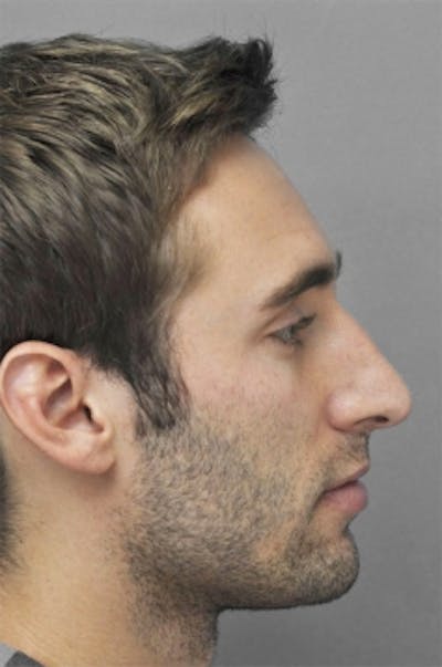 Rhinoplasty Before & After Gallery - Patient 134531 - Image 1