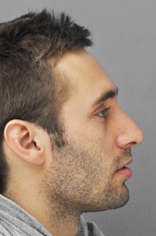 Rhinoplasty Before & After Gallery - Patient 134531 - Image 2