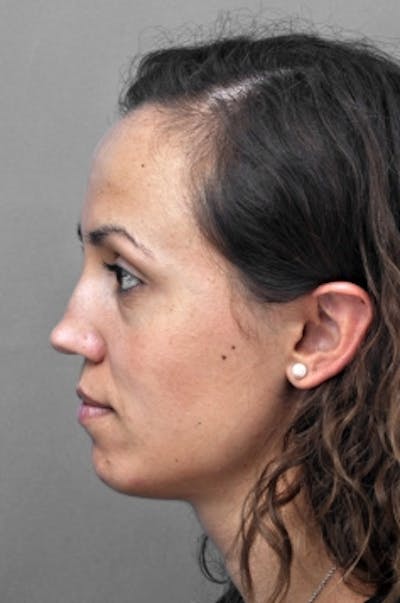 Rhinoplasty Before & After Gallery - Patient 292027 - Image 1