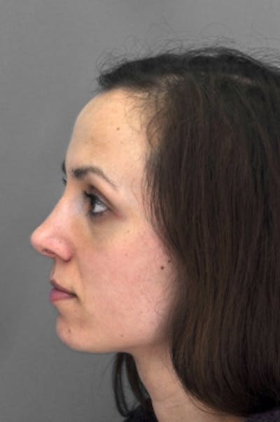 Rhinoplasty Before & After Gallery - Patient 292027 - Image 2