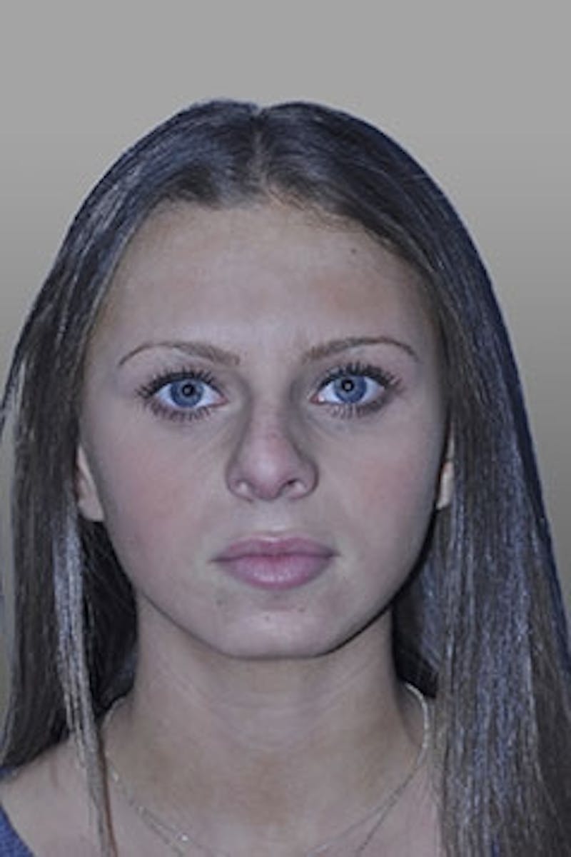 Rhinoplasty Before & After Gallery - Patient 137485 - Image 1