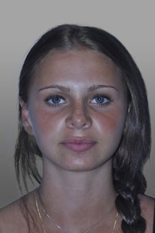 Rhinoplasty Before & After Gallery - Patient 137485 - Image 4