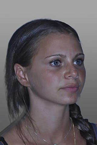 Rhinoplasty Before & After Gallery - Patient 137485 - Image 6