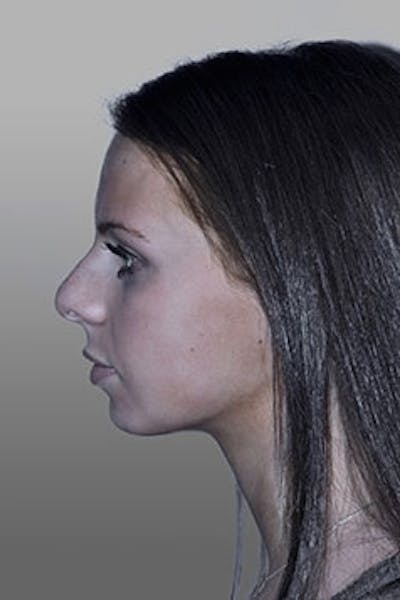 Rhinoplasty Before & After Gallery - Patient 137485 - Image 1