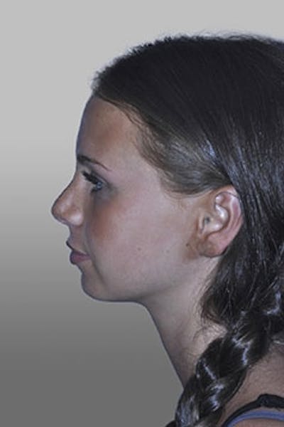Rhinoplasty Before & After Gallery - Patient 137485 - Image 2