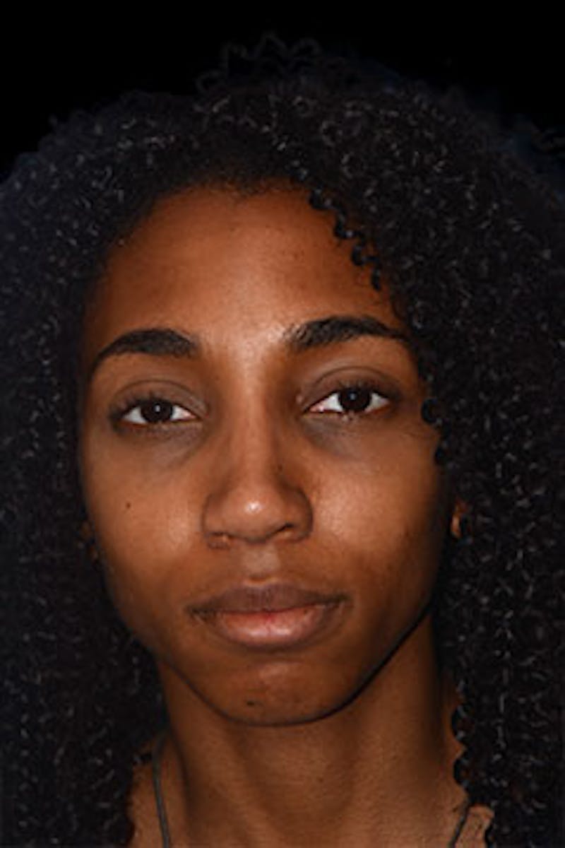 Rhinoplasty Before & After Gallery - Patient 265584 - Image 2