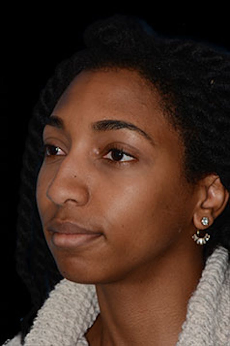 Rhinoplasty Before & After Gallery - Patient 265584 - Image 3