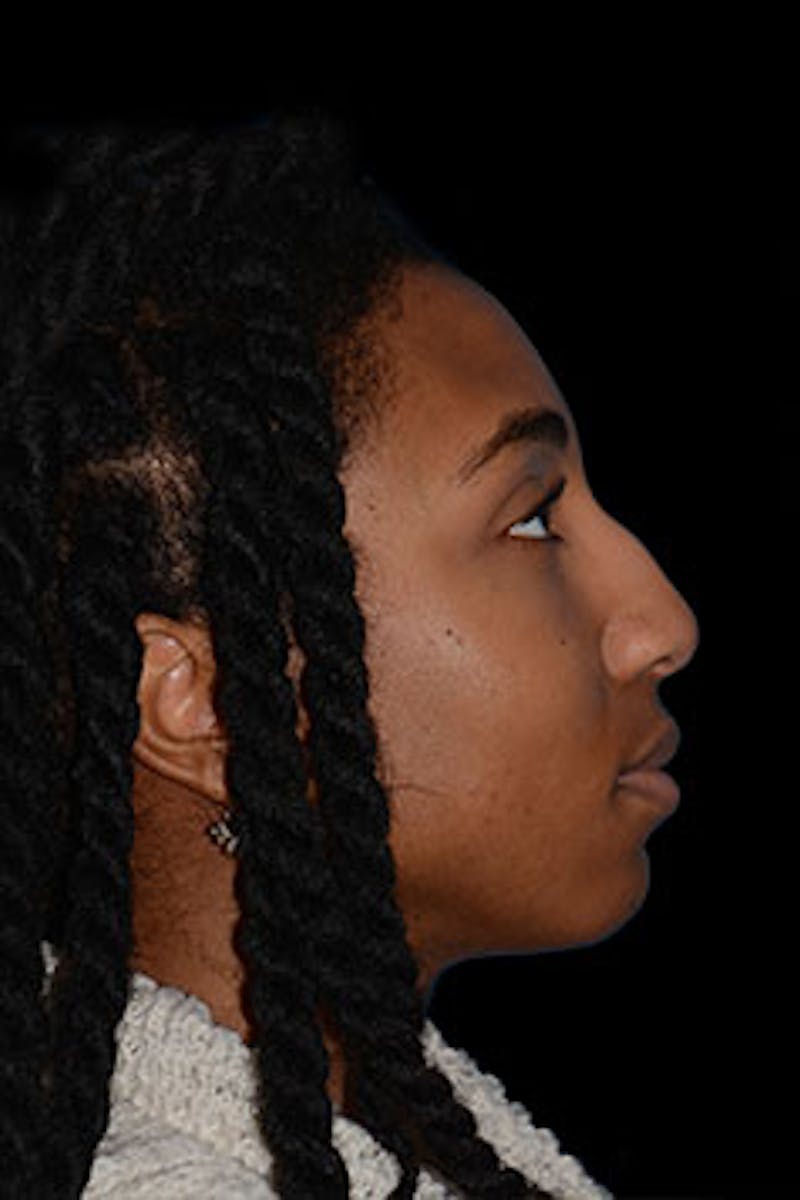 Rhinoplasty Before & After Gallery - Patient 265584 - Image 5