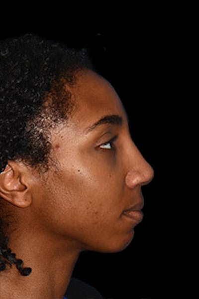 Rhinoplasty Before & After Gallery - Patient 265584 - Image 2