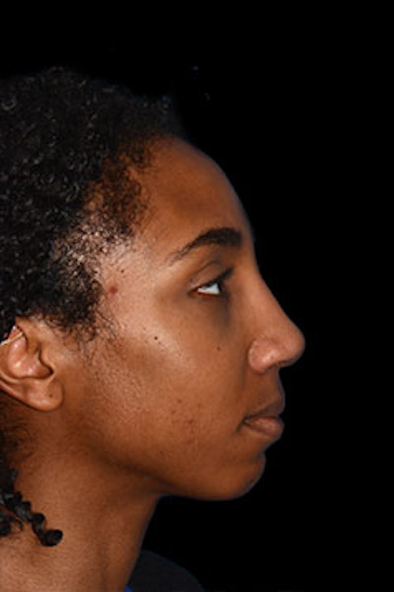 Rhinoplasty Before & After Gallery - Patient 265584 - Image 6